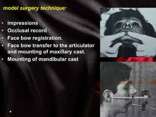 model surgery technique:
• Impressions
• Occlusal record
• Face bow registration.
• Face bow transfer to the articulator
and mounting of maxillary cast.
• Mounting of mandibular cast
 