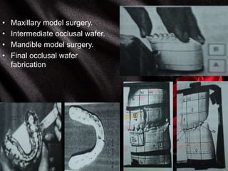 • Maxillary model surgery.
• Intermediate occlusal wafer.
• Mandible model surgery.
• Final occlusal wafer
fabrication
 