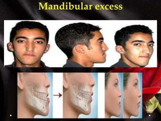 Mandibular excess
 