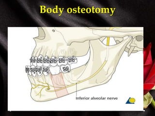 Body osteotomy
 