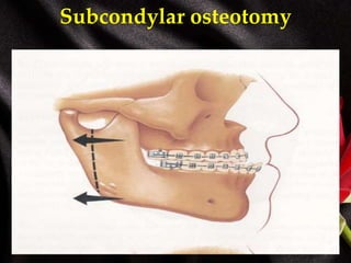 Subcondylar osteotomy
 