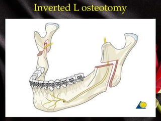 Inverted L osteotomy
 