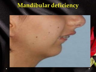 Mandibular deficiency
 