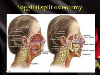 Saggital split osteotomy
 