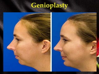 Genioplasty
 