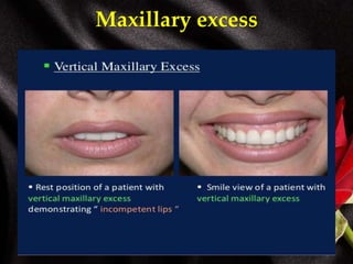 Maxillary excess
 