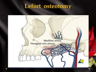 Lefort osteotomy
 