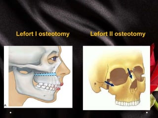 Lefort I osteotomy Lefort II osteotomy
 