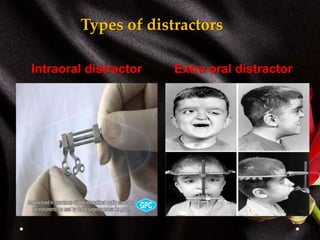 Intraoral distractor Extra oral distractor
Types of distractors
 