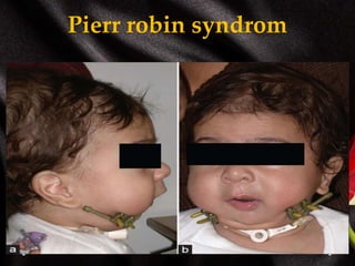 Pierr robin syndrom
 