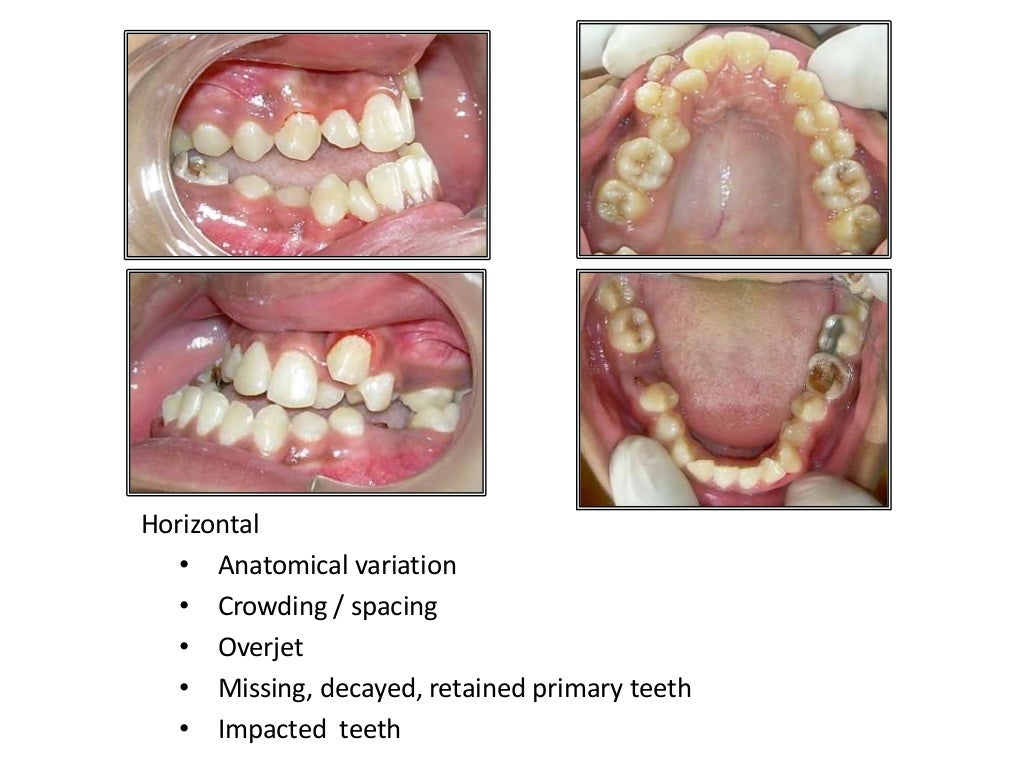 Orthognathic surgery
