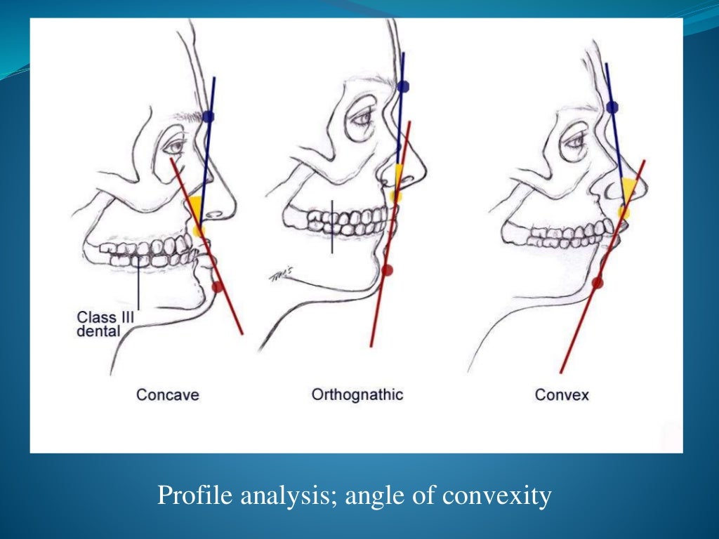 Orthognathic surgery