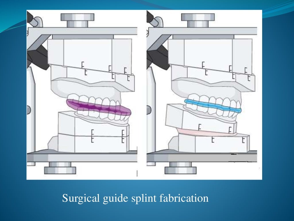 Orthognathic surgery