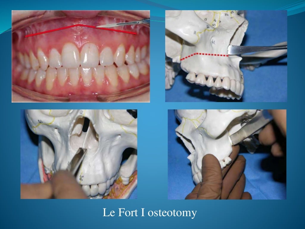 Orthognathic surgery