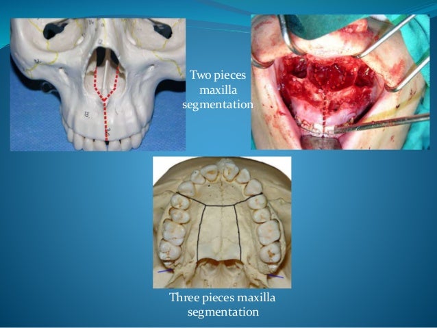 lefort osteotomies