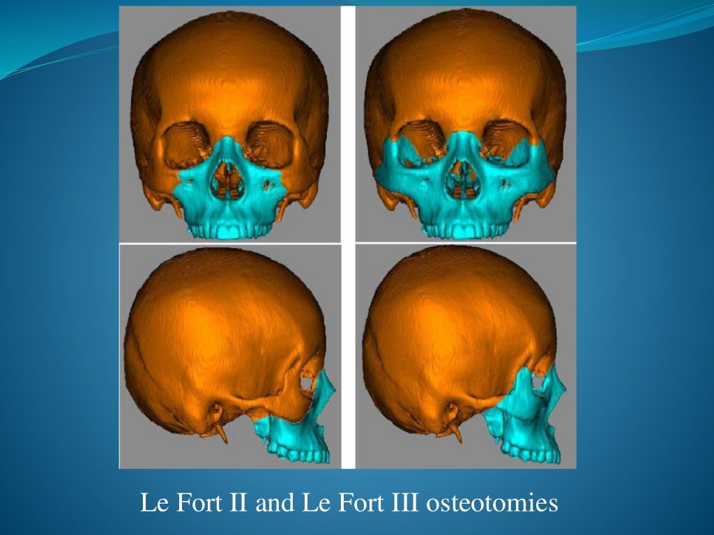 Orthognathic surgery