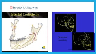  Inverted L-Osteotomy
 