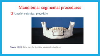 Mandibular segmental procedures
 Anterior subapical procedure
 