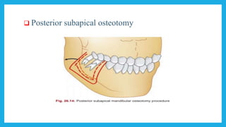  Posterior subapical osteotomy
 