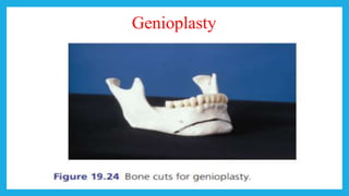 Genioplasty
 