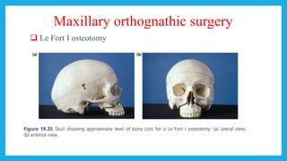 Maxillary orthognathic surgery
 Le Fort I osteotomy
 