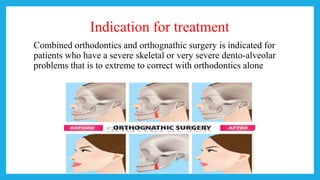 Indication for treatment
Combined orthodontics and orthognathic surgery is indicated for
patients who have a severe skeletal or very severe dento-alveolar
problems that is to extreme to correct with orthodontics alone
 