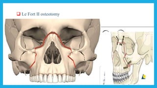  Le Fort II osteotomy
 