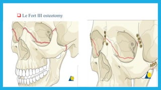  Le Fort III osteotomy
 