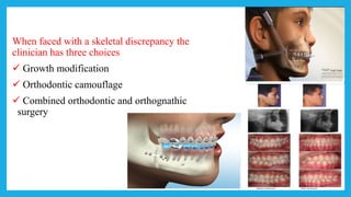 When faced with a skeletal discrepancy the
clinician has three choices
 Growth modification
 Orthodontic camouflage
 Combined orthodontic and orthognathic
surgery
 
