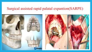 Surgical assisted rapid palatal expantion(SARPE)
 