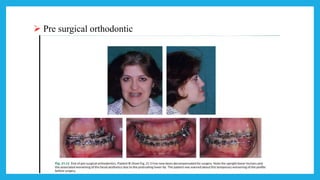  Pre surgical orthodontic
 