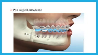  Post surgical orthodontic
 