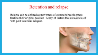 Retention and relapse
Relapse can be defined as movement of osteotomized fragment
back to their original position . Many of factors that are associated
with post treatment relapse:-
 