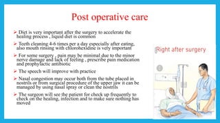 Post operative care
 Diet is very important after the surgery to accelerate the
healing process , liquid diet is common
 Teeth cleaning 4-6 times per a day especially after eating,
also mouth rinsing with chlorohexidine is very important
 For some surgery , pain may be minimal due to the minor
nerve damage and lack of feeling , prescribe pain medication
and prophylactic antibiotic
 The speech will improve with practice
 Nasal congestion may occur both from the tube placed in
nostrils or from surgical procedure of the upper jaw it can be
managed by using nasal spray or clean the nostrils
 The surgeon will see the patient for check up frequently to
check on the healing, infection and to make sure nothing has
moved
 