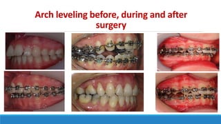 Arch leveling before, during and after
surgery
 