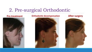 2. Pre-surgical Orthodontic
Pre-treatment Orthodontic decompensation After surgery
 