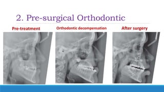 2. Pre-surgical Orthodontic
Pre-treatment Orthodontic decompensation After surgery
 