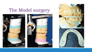 The Model surgery
 
