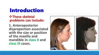Introduction
These skeletal
problems can include:
1. Anteroposterior
disproportion associated
with the size or position
of the maxilla and
mandible in class II and
class III cases.
 