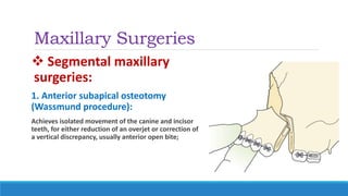 Maxillary Surgeries
 Segmental maxillary
surgeries:
1. Anterior subapical osteotomy
(Wassmund procedure):
Achieves isolated movement of the canine and incisor
teeth, for either reduction of an overjet or correction of
a vertical discrepancy, usually anterior open bite;
 