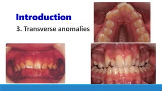 Introduction
3. Transverse anomalies
 