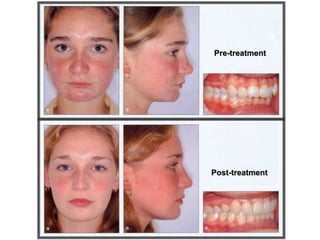 Pre-treatment
Post-treatment
 