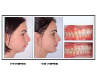 Pre-treatment Post-treatment
 