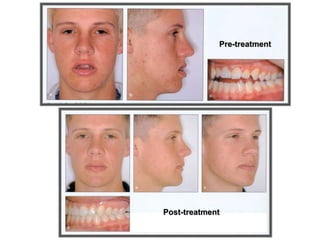 Pre-treatment
Post-treatment
 