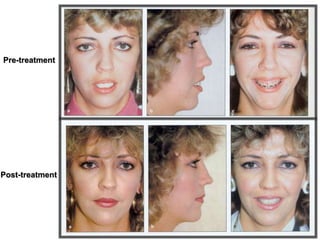 Pre-treatment
Post-treatment
 