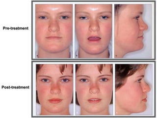 Pre-treatment
Post-treatment
 