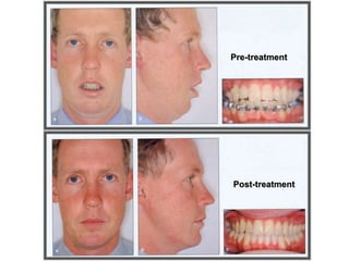Pre-treatment
Post-treatment
 