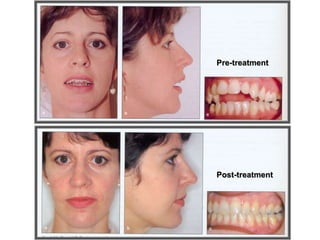 Pre-treatment
Post-treatment
 