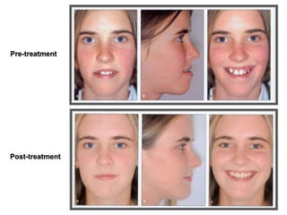 Pre-treatment
Post-treatment
 