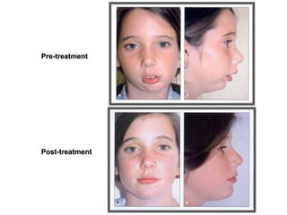 Pre-treatment
Post-treatment
 